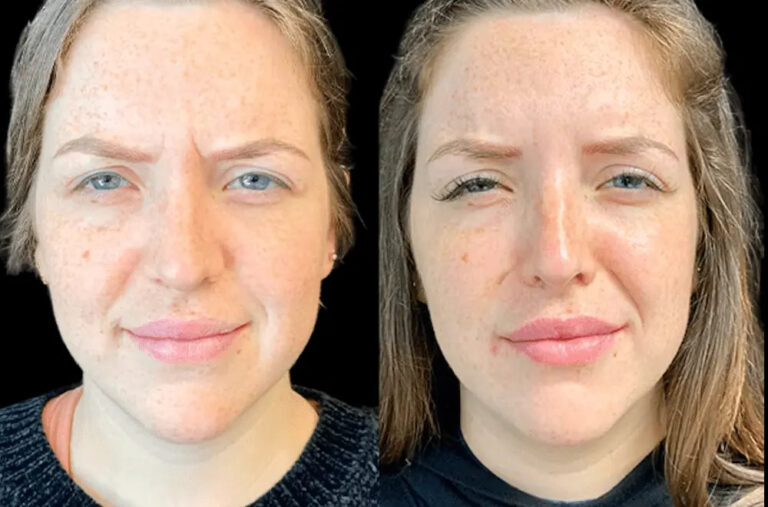 Long-Lasting Results: How Botox Treatments in Dubai Work