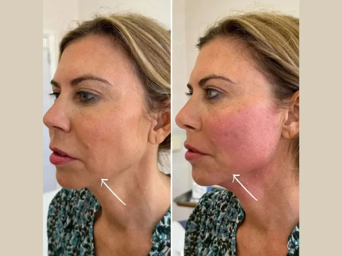 Endolift in Dubai for Facial Contouring Without Downtime