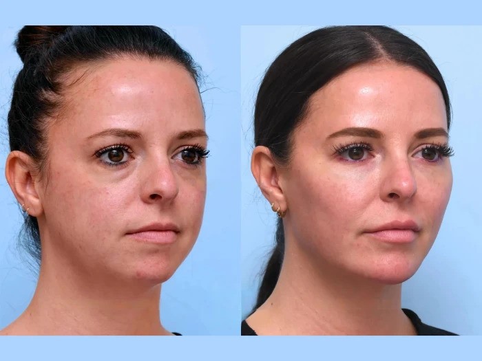 Best Aesthetic Clinics in Dubai Specializing in Safe Thread Lift Procedures