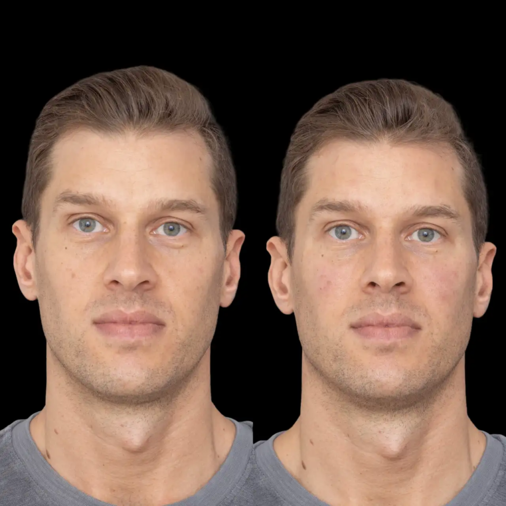 Jawline Fillers in Dubai