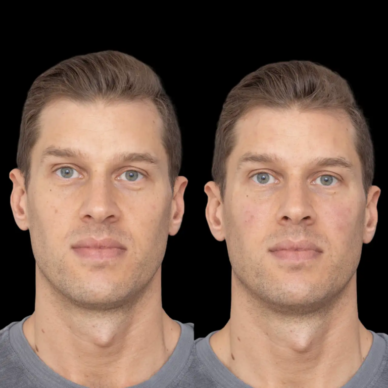 Jawline Fillers in Dubai