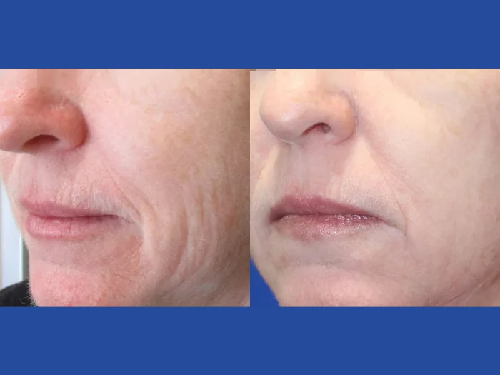 fractional-rf-microneedling