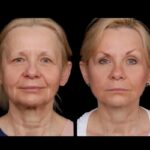 under eye fillers