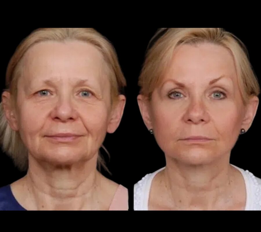 under eye fillers