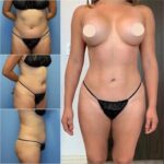 Body Contouring in Dubai