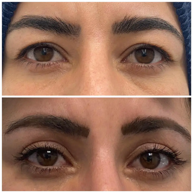 Eye Bag Removal in Dubai