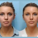 Trusted Non Surgical Thread Lift Treatment in Dubai