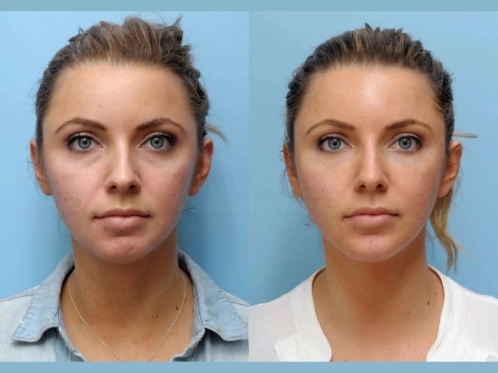Trusted Non Surgical Thread Lift Treatment in Dubai
