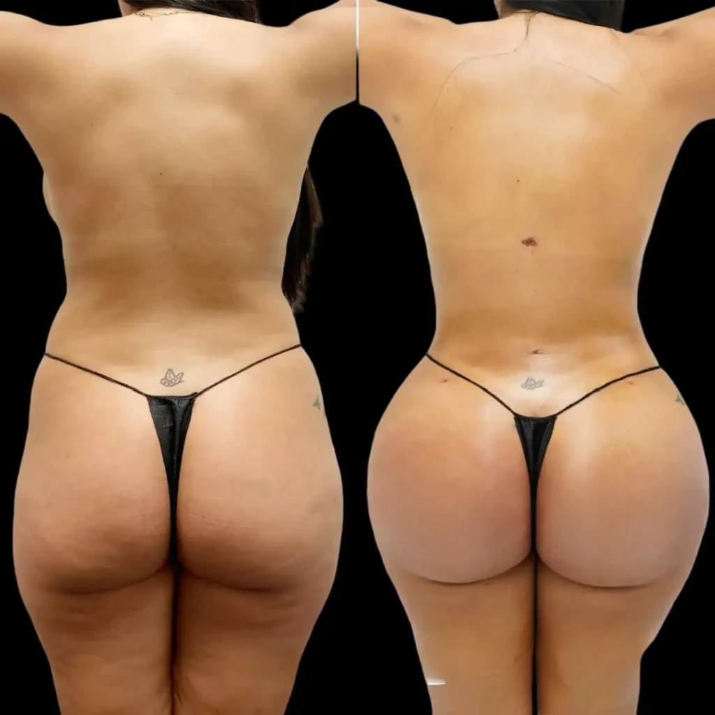 Fat Transfer in Dubai