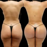 Fat Transfer in Dubai