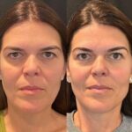 High Quality Thread Lift Treatments in Dubai Using Advanced PDO Techniques