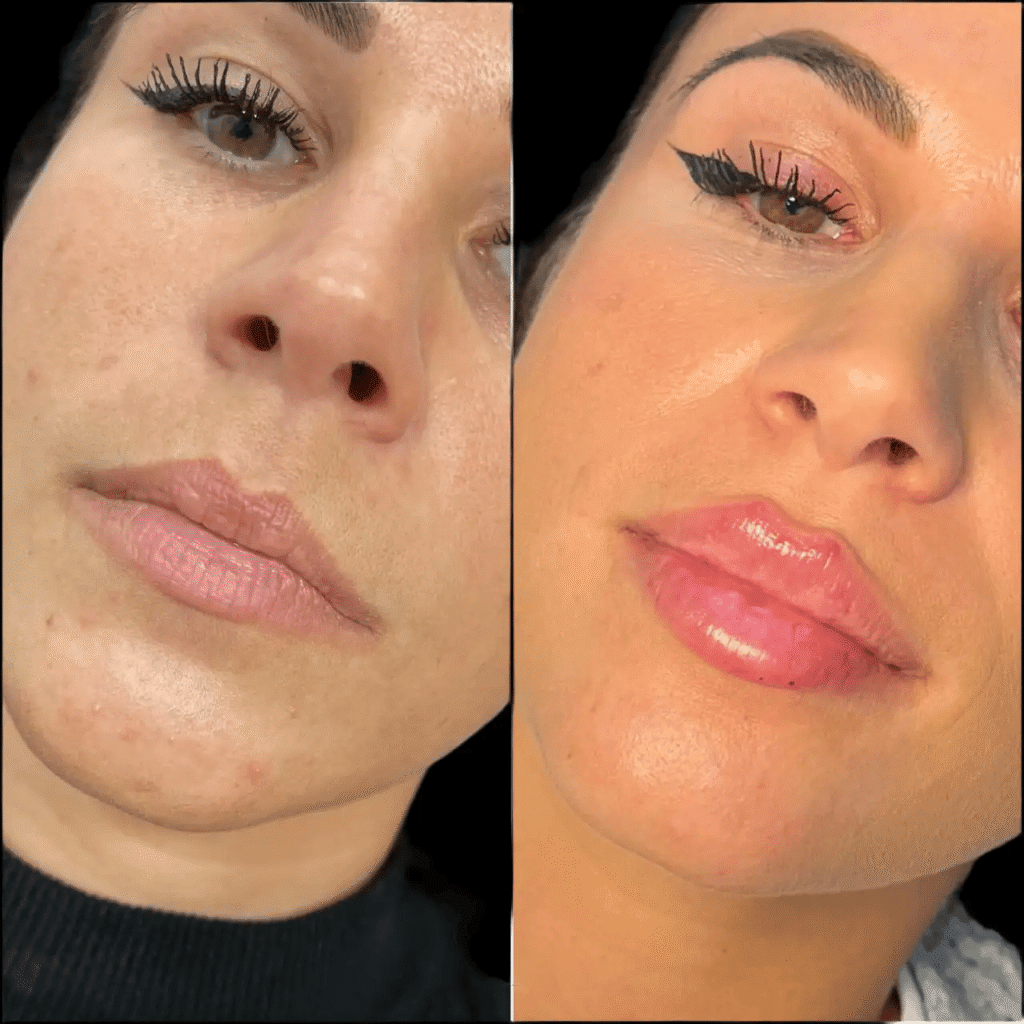 Russian Lip Fillers