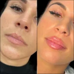 Russian Lip Fillers