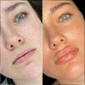 fillers