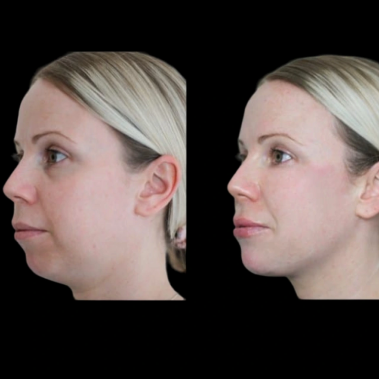 Jawline Fillers in Dubai