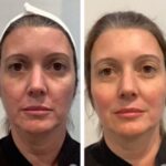 Best Plastic Surgeons in Dubai Thread Lift Procedures offering Personalized Treatment Plans