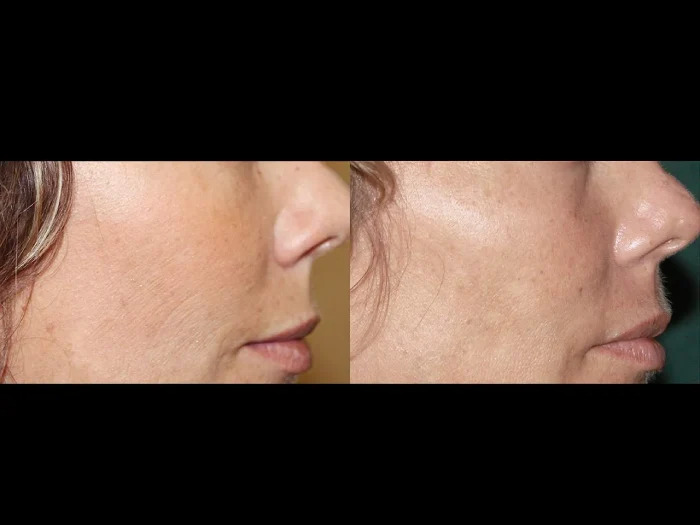 Fractional RF Microneedling in Dubai