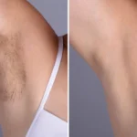 Skin Boosters in Dubai