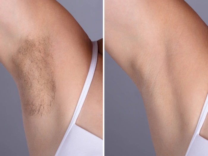 Skin Boosters in Dubai