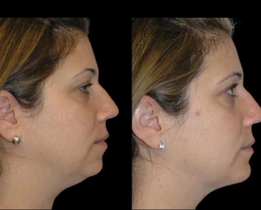 Double chin removal in Dubai