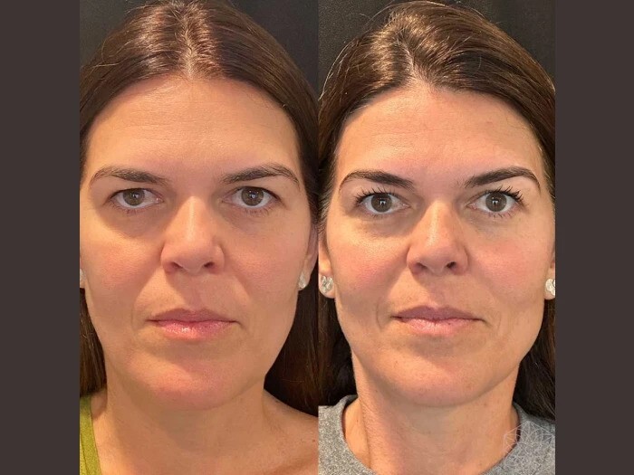 Best Doctors in Dubai Delivering High Quality Aesthetic Thread Lift Solutions