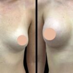 Breast Enhancement in dubai