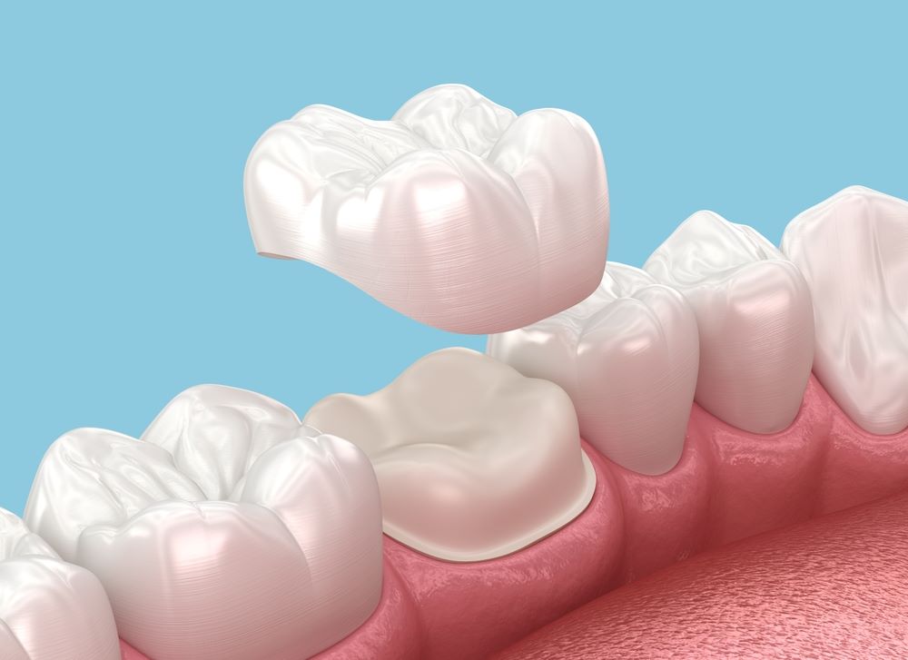 dental crown dubai
