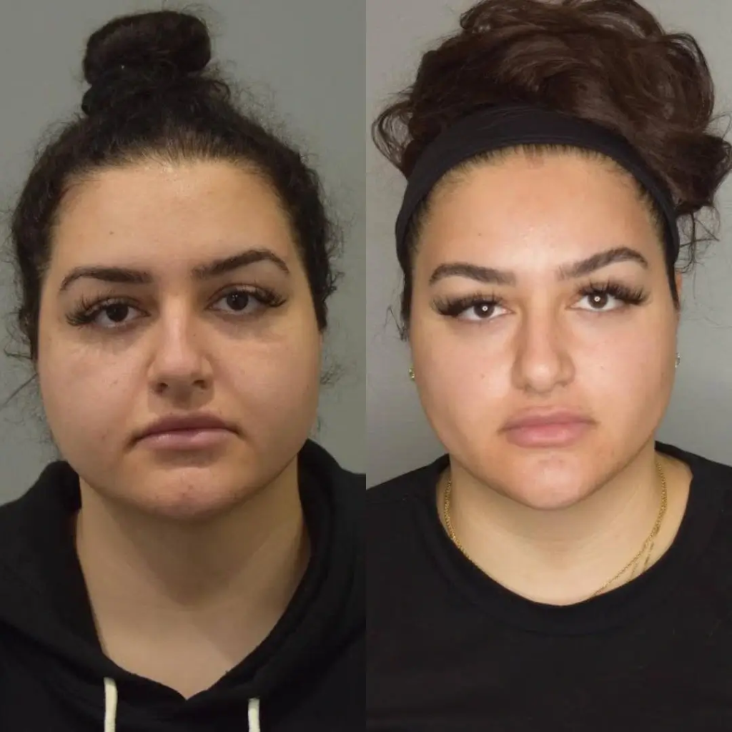Buccal Fat Removal in Dubai