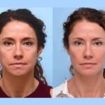 Thread Lift at Best Aesthetic Clinics in Dubai For Effective Skin Lifting
