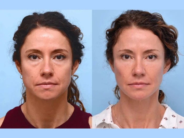 Thread Lift at Best Aesthetic Clinics in Dubai For Effective Skin Lifting
