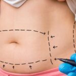 mini tummy tuck dubai