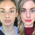 Radiofrequency (RF) Microneedling Treatment in Dubai