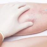 Sclerotherapy in dubai