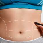 abdominoplasty in jeddah