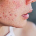 acne-removal-treatment-dubai-1024x683