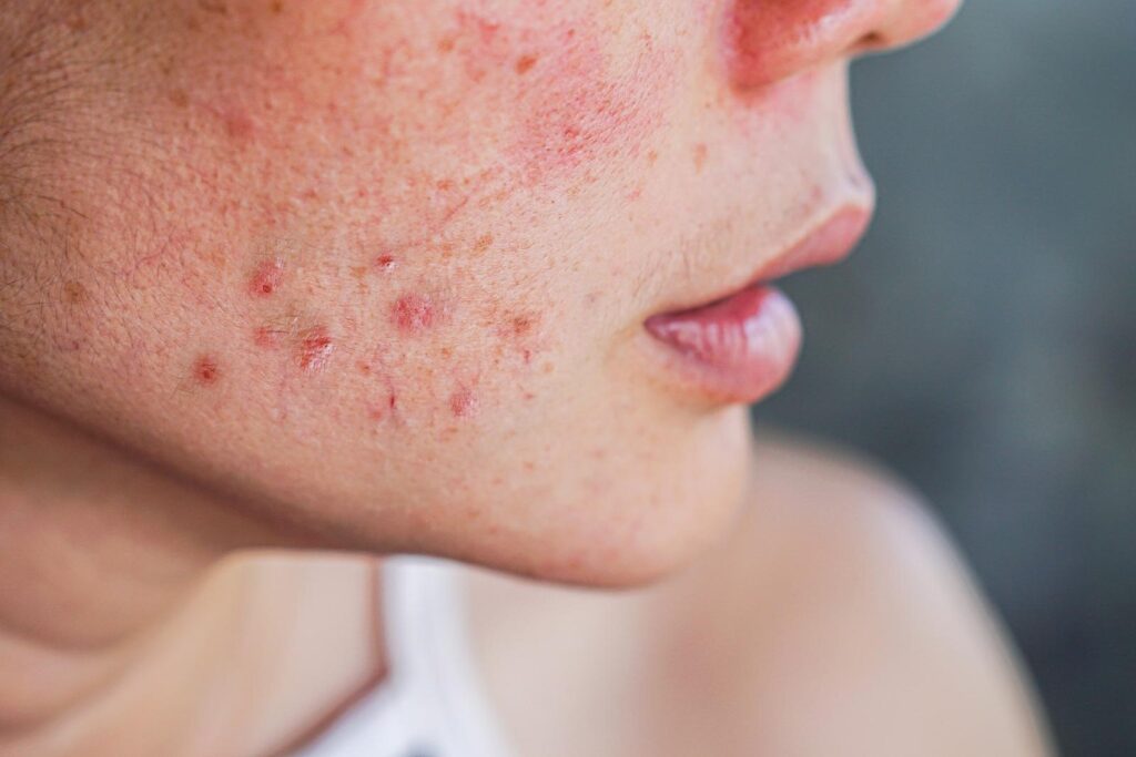 acne-removal-treatment-dubai-1024x683