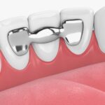 dental bridge