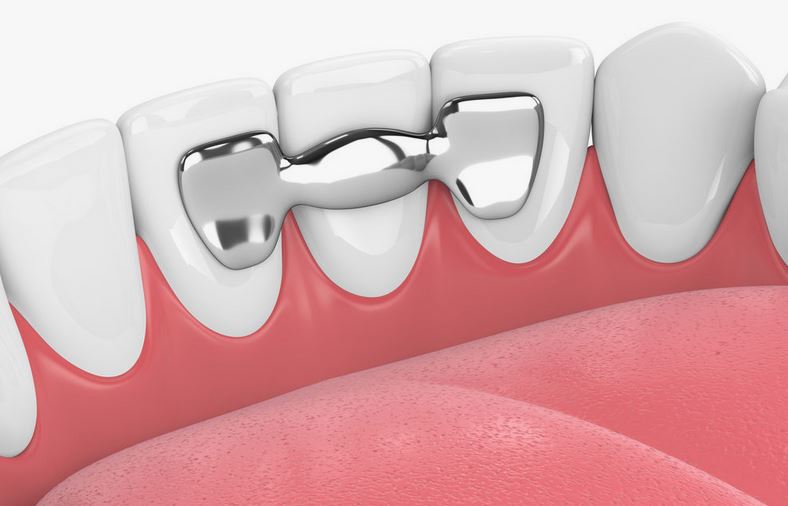 dental bridge
