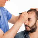 stem-cell-hair-transplant-1200x720