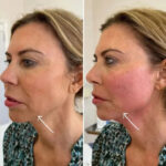 Endolift in Dubai improving facial symmetry with advanced contouring techniques