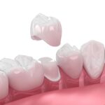 Tooth Crown Dubai