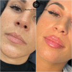 Juvederm in Dubai