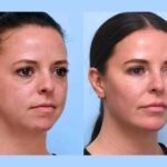 Thread lift in Dubai Providing Reliable Aesthetic Results