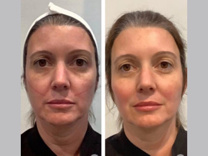 Thread lift in Dubai With Trusted Professional Cosmetic Expertise