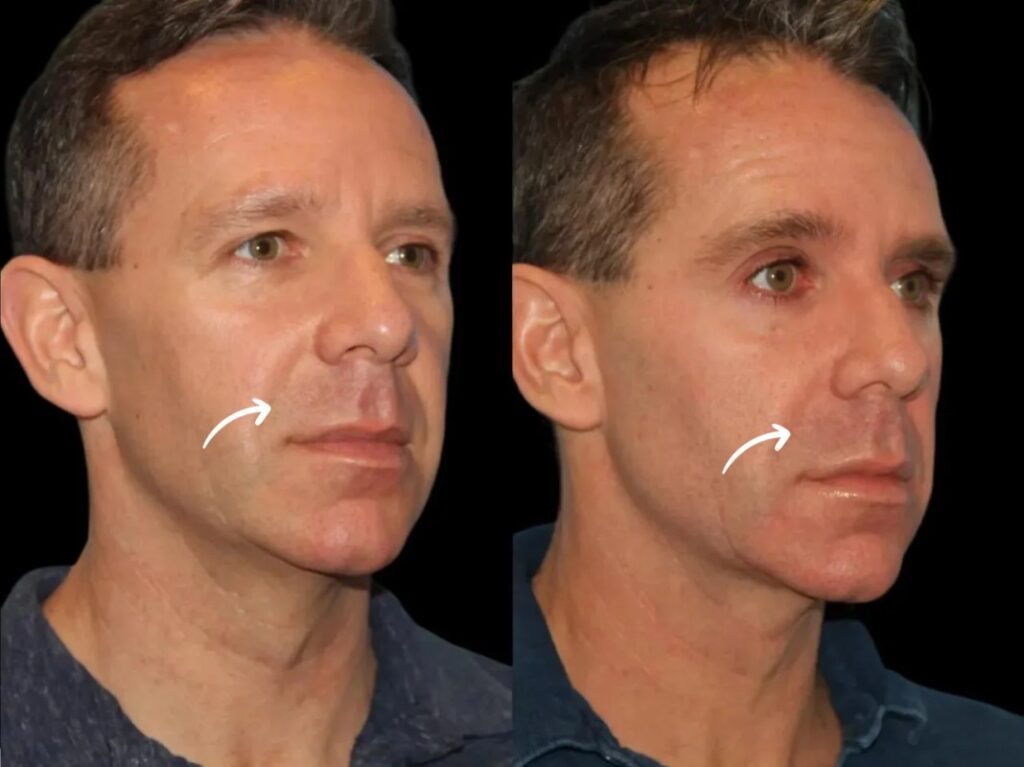 sculptra fillers in dubai