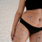 Liposuction in Dubai