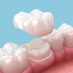 understanding-dental-crowns-and-bridges-what-they-are-and-how-they-work