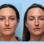 Best Plastic Surgeon in Dubai: Facial Tightening Through Advanced Thread Lift