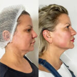 Best Plastic Surgeons in dubai for Endolift Skin Tightening