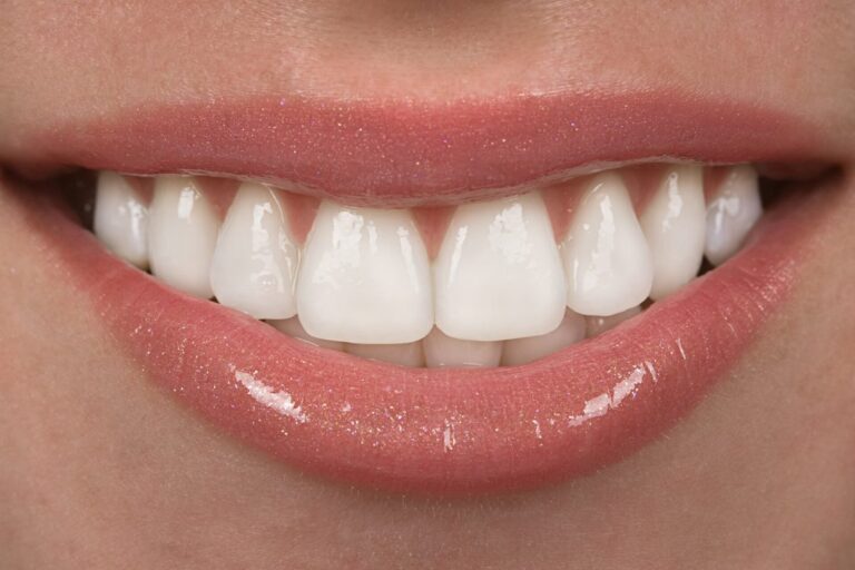 Achieve a Flawless Smile with Expert Veneer Insights the Power of Dental Veneers in West Houston